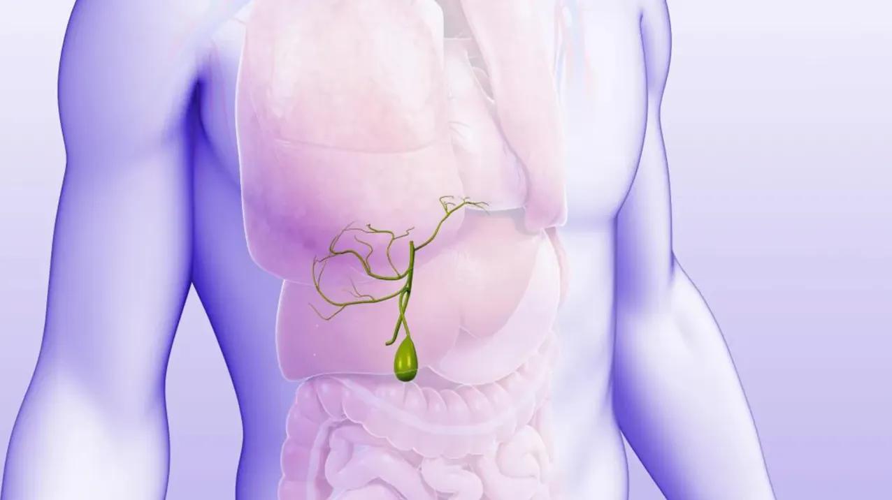 علائم سنگ کیسه صفرا | علت درد کیسه صفرا