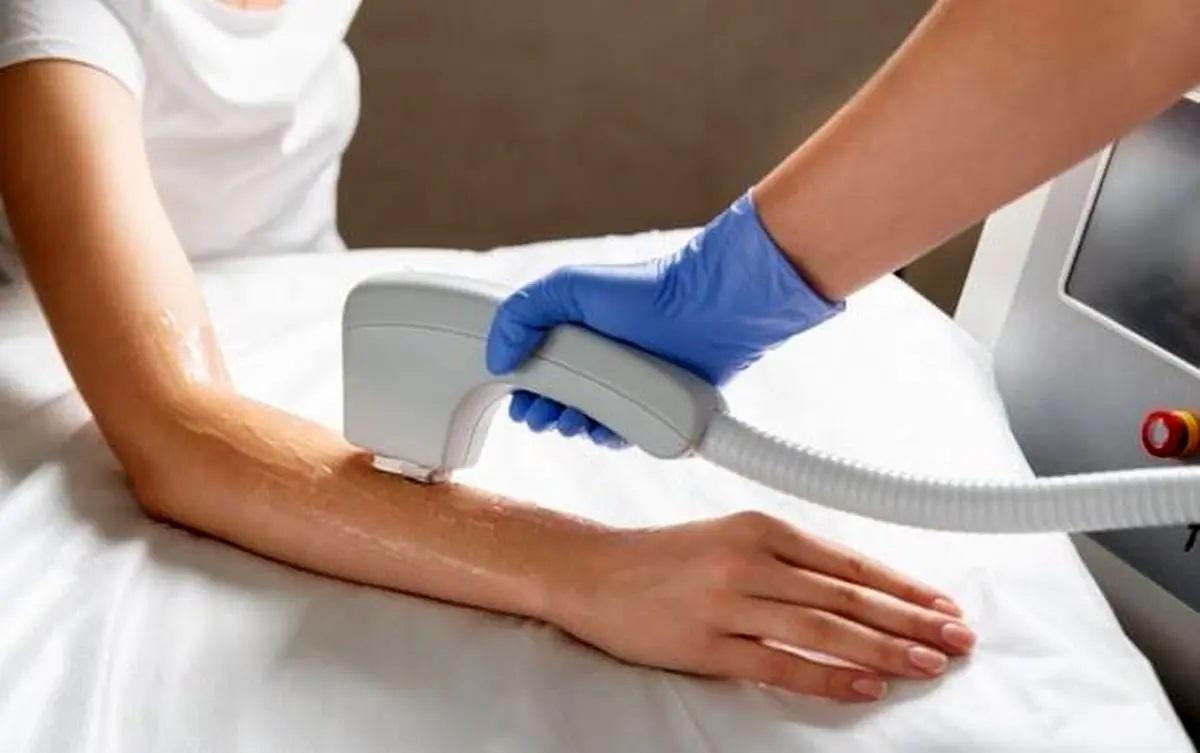 لیزر موهای زائد؛ نکات طلایی برای جلوگیری از عوارض ناخواسته