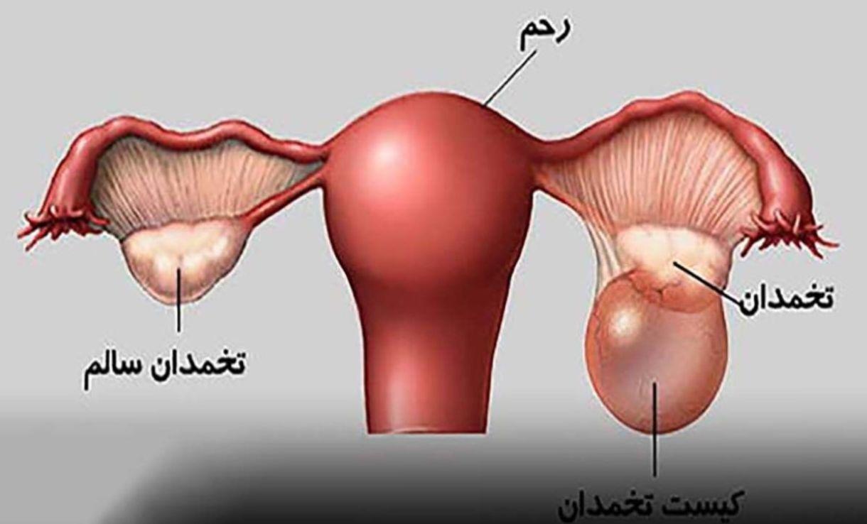 درمان خانگی کیست تخمدان؛ قبل از هر اقدامی برای عمل جراحی این روش را امتحان کن+ویدئو