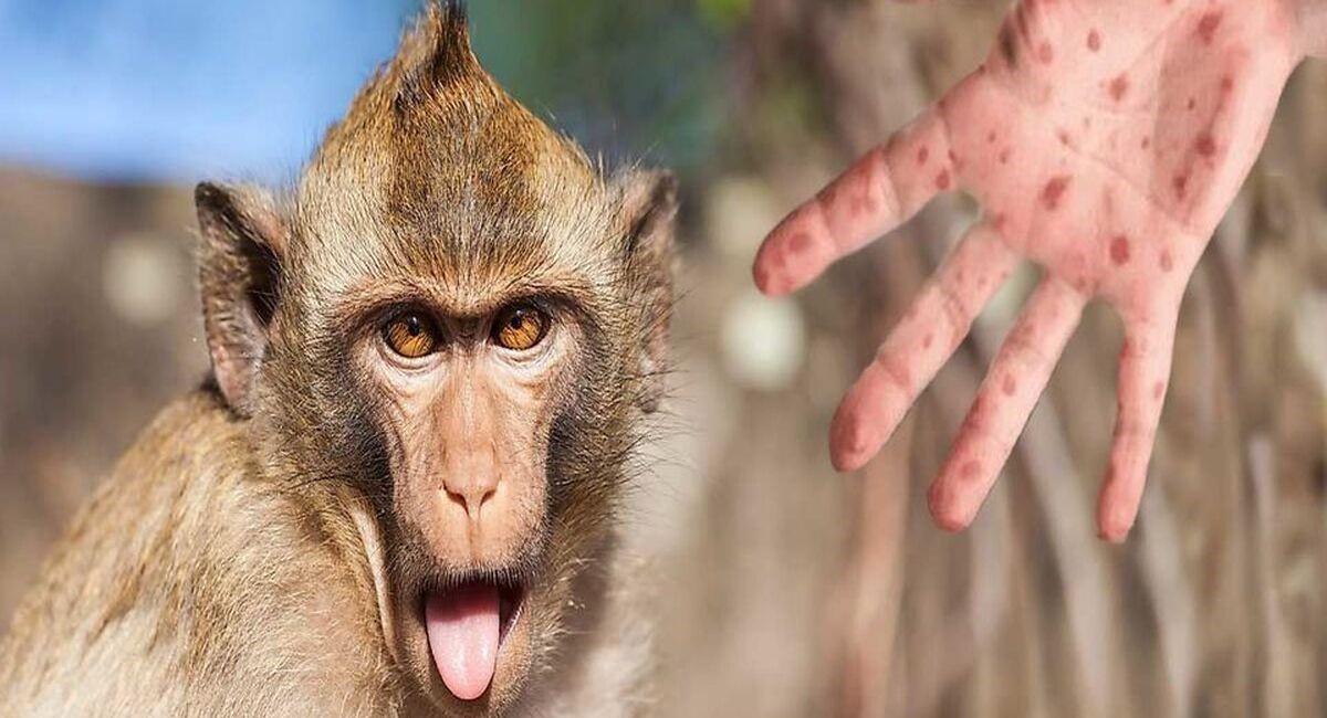 شیوع سویه جدید آبله میمون | روش انتقال ویروس ام‌پاکس و علائم آن