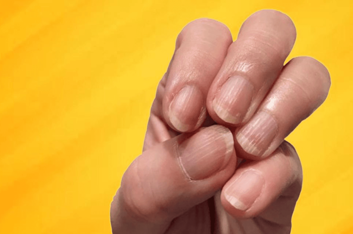 علت ایجاد خطوط عمودی و افقی روی ناخن‌ها چیست؟