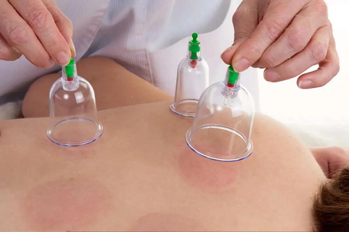 فواید حجامت در فصل تابستان