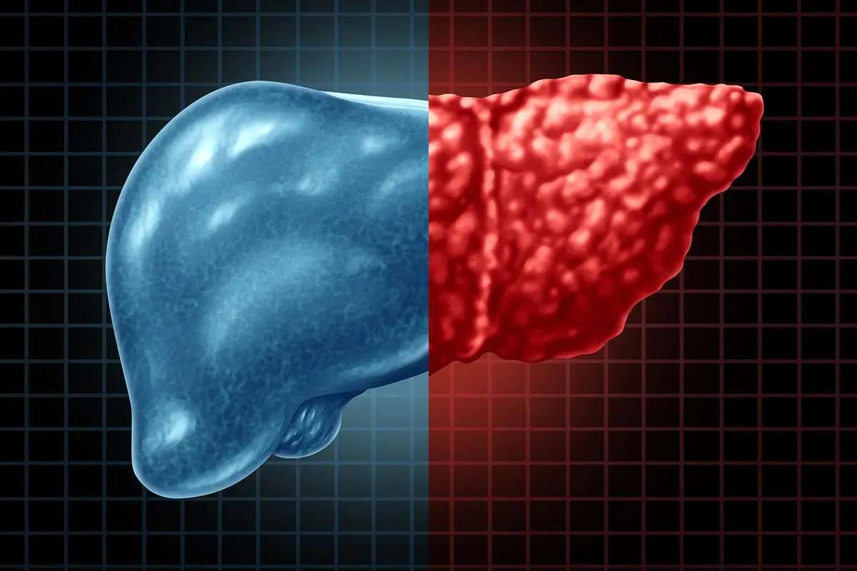 آیا شما هم علائم این بیماری مرگبار خاموش را دارید؟