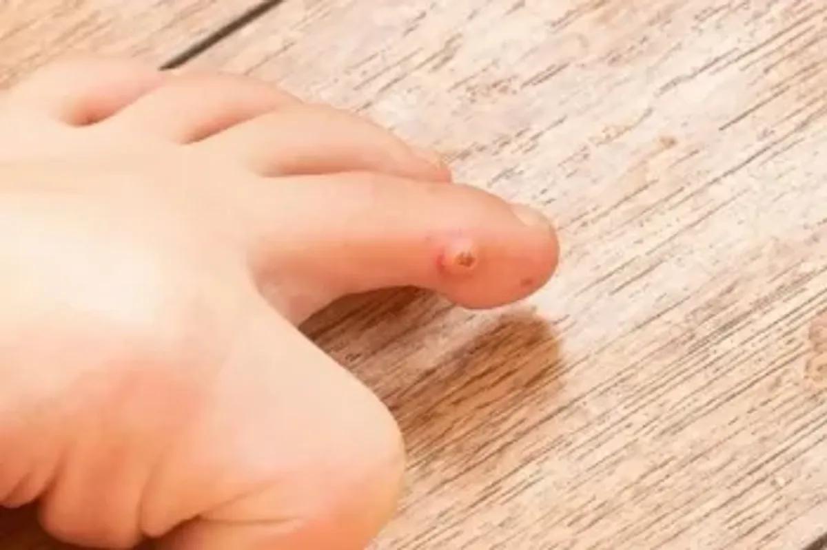 تکنولوژی سرما در خدمت زیبایی پوست | کرایوتراپی، روشی مدرن برای حذف میخچه و زوائد