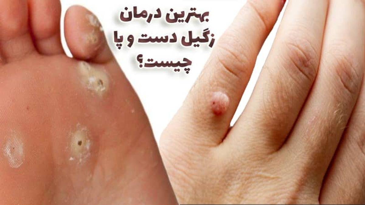 درمان سریع زگیل با طب سنتی | درمان خانگی زگیل با شیره انجیر، سیر و پیاز و نوره