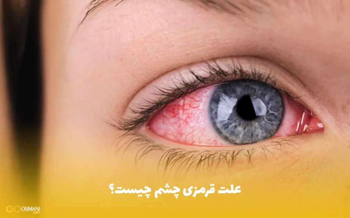 قرمزی چشم نشانه چیست؟؛ این 7 دلیل باعث قرمزی چشم می شود